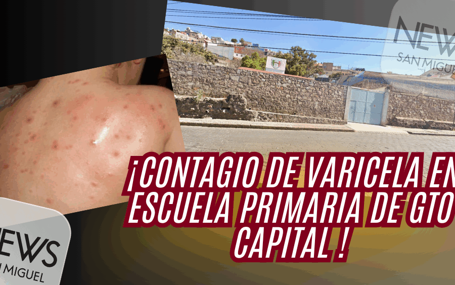 ¡Brote de varicela en escuela primaria de Guanajuato!